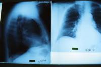 Пневмоцистная пневмония - причины, течение и профилактика заболевания